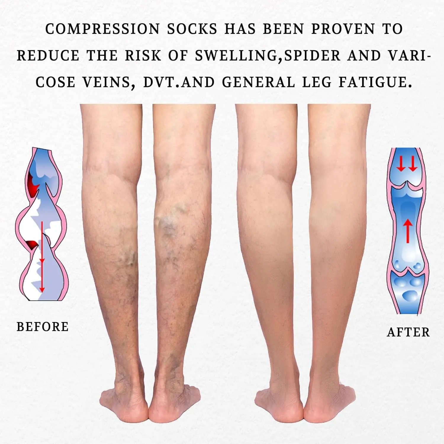 LIN PERFORMANCE Compression Socks for Women and Men Knee High Open Toe Medical Compression Stockings Varicose Vein Swollen legs Travel